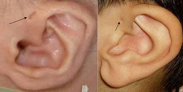 preauricular-pit