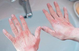 handwashingandrash-1a94924f3a534a1d9ecb54b2a6e56822-1000x650